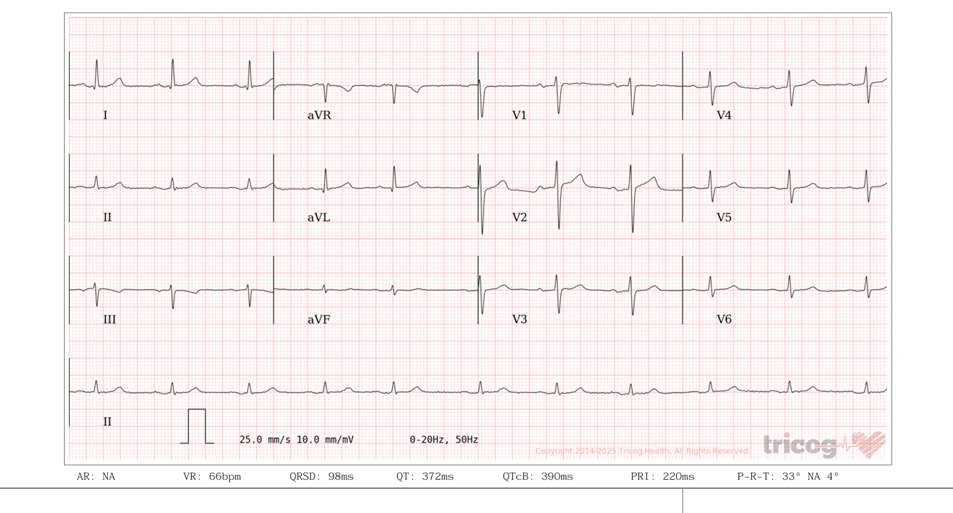 ECG AI App Screenshot